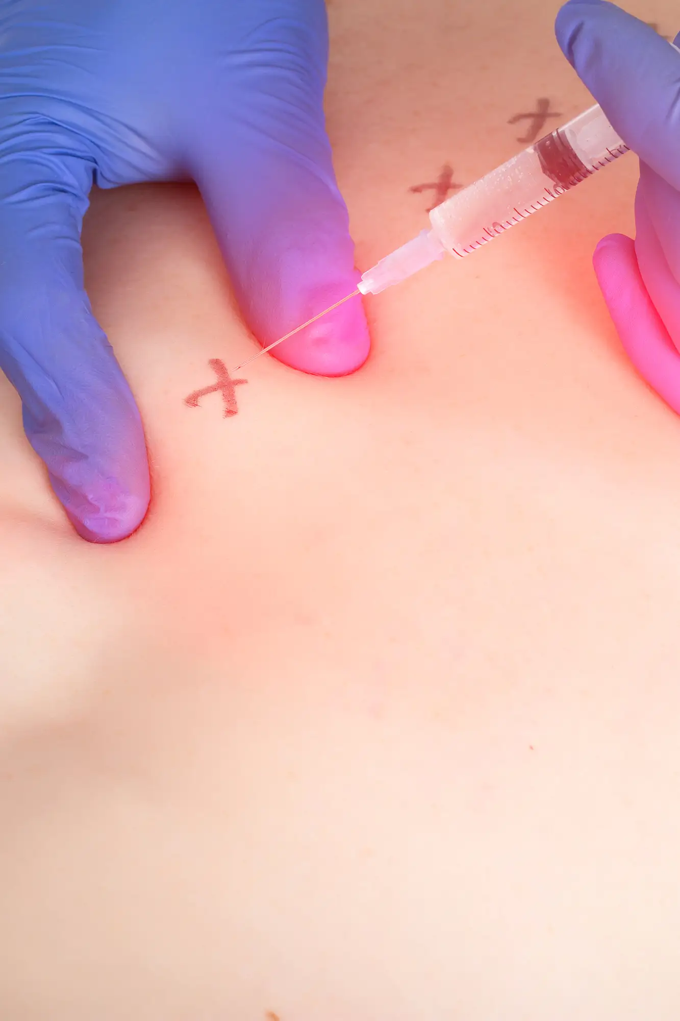 Infiltrazioni ozonoterapia per la schiena Centro Bernstein Verona preventivo prezzo